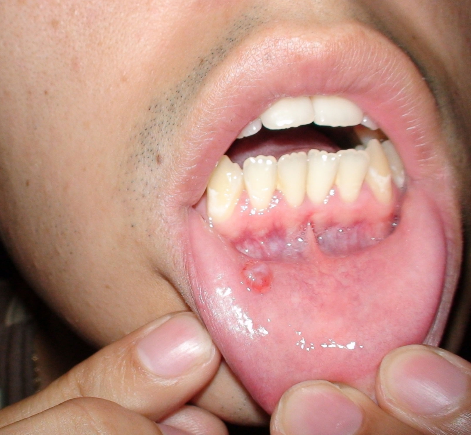 Mucous Cyst Lip 5349