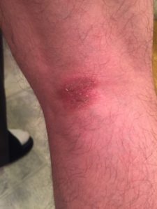 Eczema-like yeast on the back of knees
